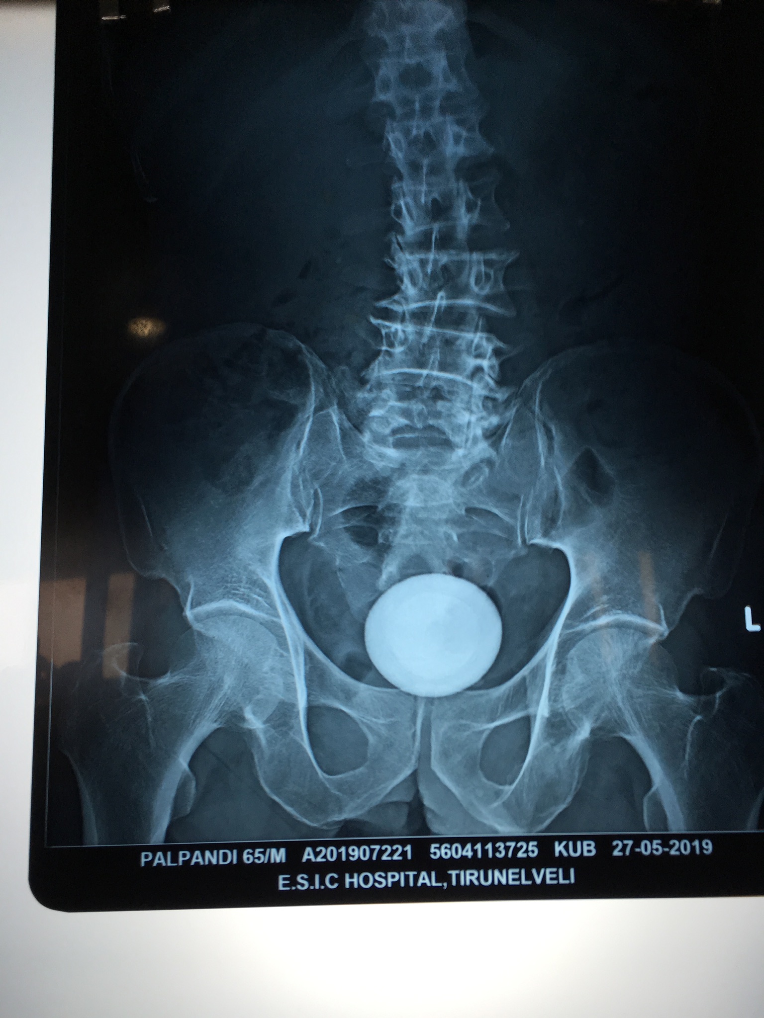 An Incidental Finding In X- Ray